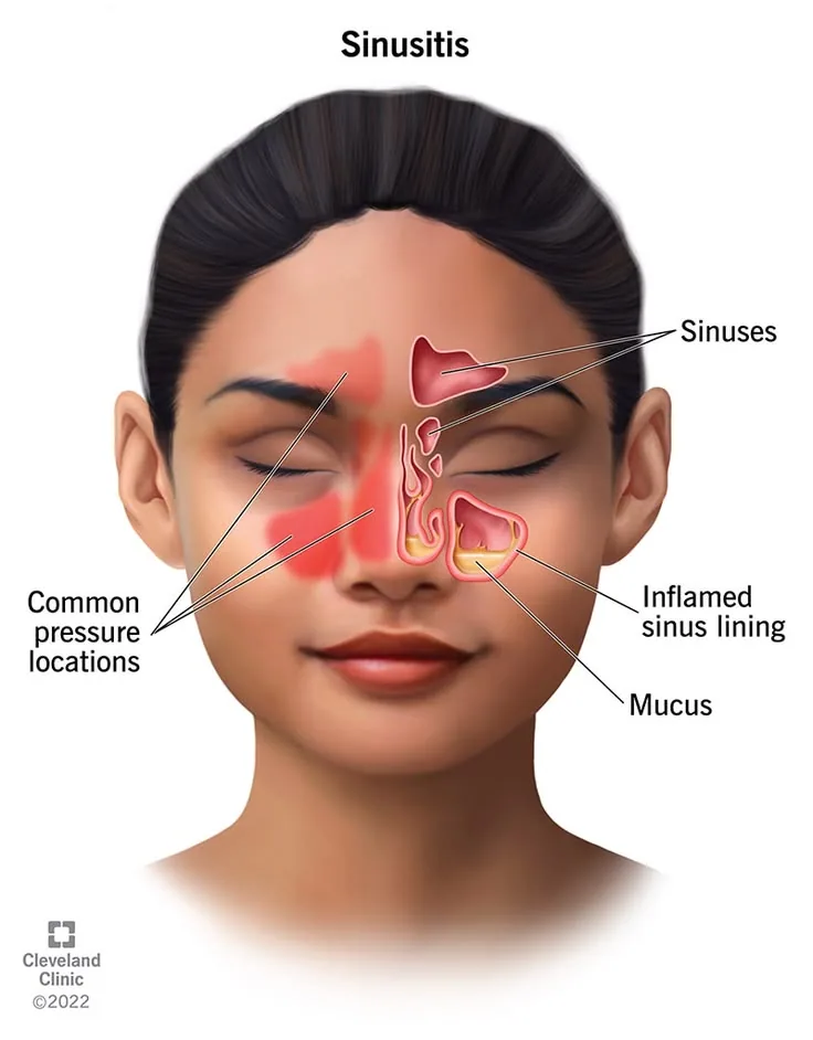 Rhinitis allergy Ayurveda